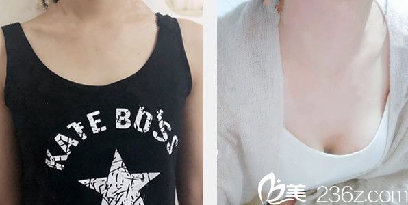 蘭州亞韓雷蓓醫(yī)生曼托假體隆胸效果案例 蘭州亞韓雷蓓醫(yī)生曼托假體隆胸效果案例