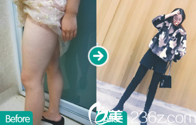 成都西區(qū)醫(yī)院大腿吸脂術(shù)后效果對比