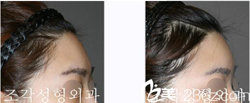 額頭整形<span style=