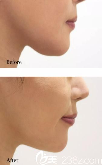 院長渡邊裕之  下巴削骨