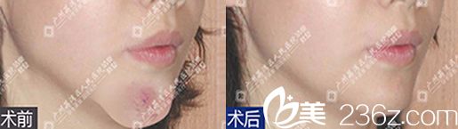 廣州荔灣區(qū)醫(yī)院整形美容清除奧美定后下巴恢復(fù)正常