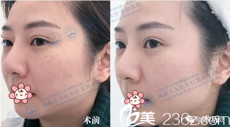 馮永強(qiáng)BBL美膚治療案例