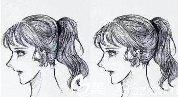 后腦勺整形漫畫圖 后腦勺整形漫畫圖