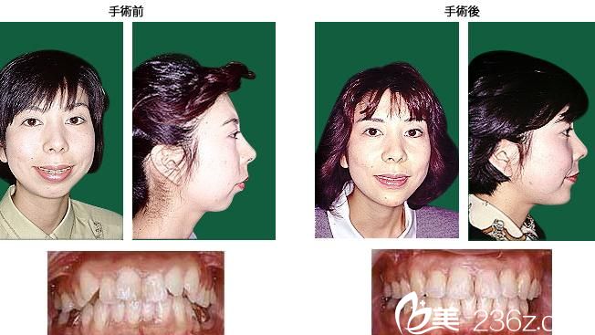鶴木隆上顎前凸+反對(duì)咬合 鶴木隆上顎前凸+反對(duì)咬合