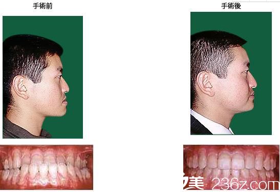 鶴木隆下顎前凸+反對(duì)咬合 鶴木隆下顎前凸+反對(duì)咬合