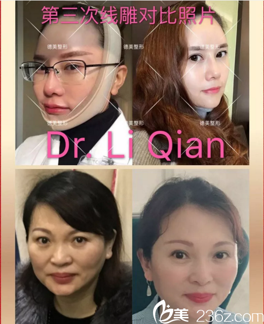 德美360° 網(wǎng)雕逆齡術(shù)真人案例對比