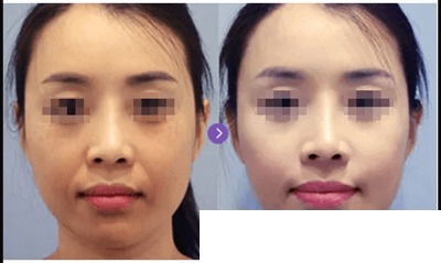 童顏水凝效果案例展示