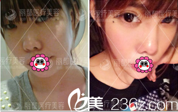 北京米蘭柏羽麗都曹衛(wèi)華雙眼皮實(shí)例