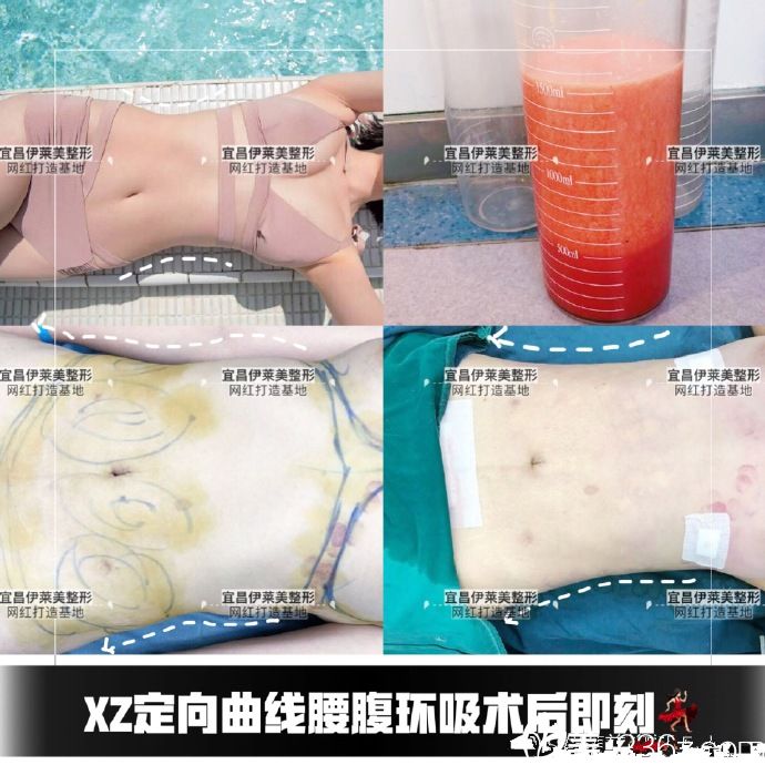 宜昌伊萊美腰腹部吸脂案例