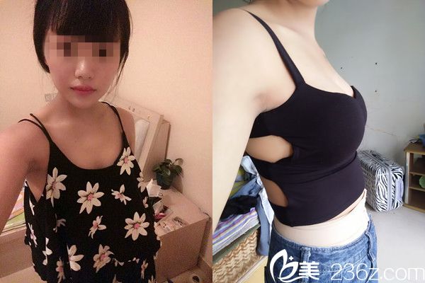 吳毅平假體隆胸案例