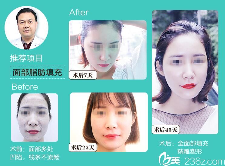 周光瑜面部脂肪填充案例