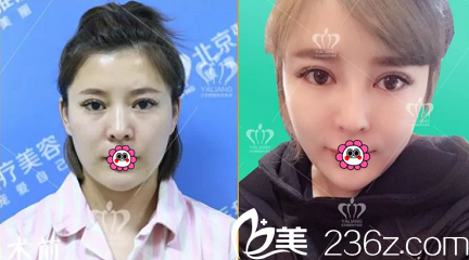 北京雅靚陳林葉醫(yī)生腰腹吸脂+自體脂肪面部填充案例