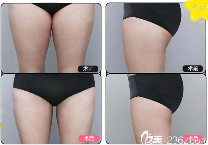大腿吸脂案例