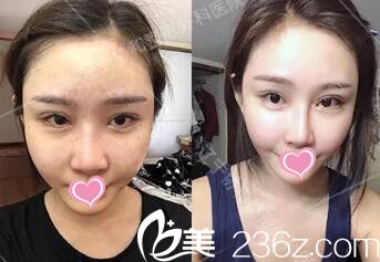 自體脂肪填充全臉術(shù)后第7天