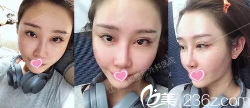 做自體脂肪填充全臉+假體墊下巴術(shù)后半個(gè)月