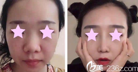 運城華美整形鼻綜合整形前后對比圖 運城華美整形鼻綜合整形前后對比圖