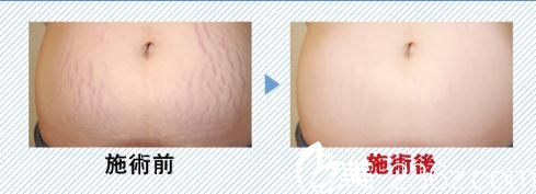 妊娠紋治療 妊娠紋治療