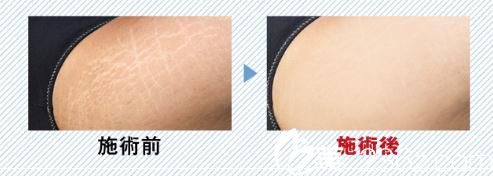 妊娠紋治療 妊娠紋治療