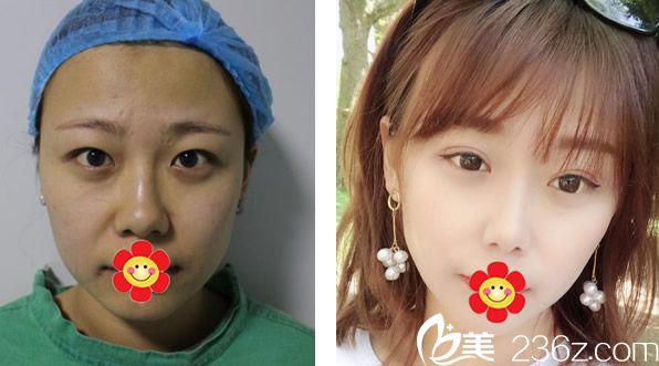 包頭葉子馮守運(yùn)院長全切雙眼皮+自體脂肪面部填充效果