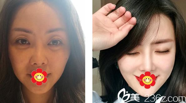 包頭葉子彭?xiàng)澚横t(yī)生假體隆鼻+自體軟骨隆鼻+面部線雕三個(gè)月效果對比案例