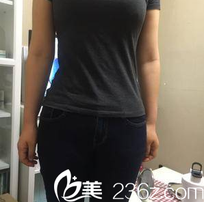 北京雅靚張春彥水動(dòng)力腰腹吸脂案例 北京雅靚張春彥水動(dòng)力腰腹吸脂案例