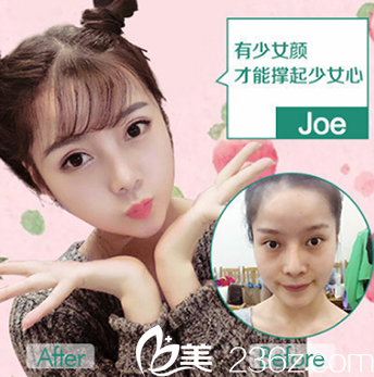 脂肪填充面部案例