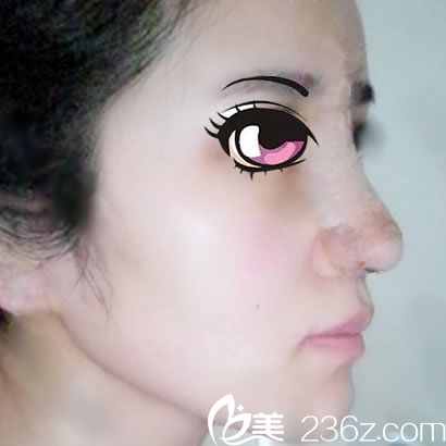 做完鼻綜合隆鼻手術(shù)3天照