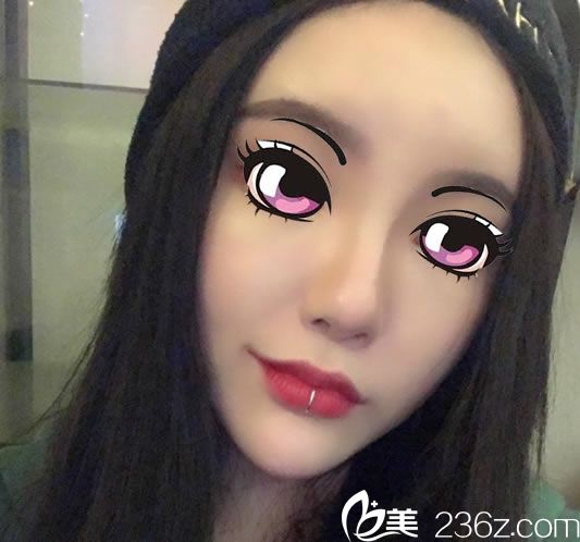 在寧波尚麗我剛做鼻綜合隆鼻的效果