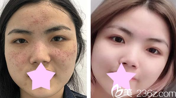 美萊李大鐵院長(zhǎng)祛斑效果對(duì)比圖