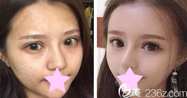 美萊宋萍院長(zhǎng)自體脂肪面部填充效果對(duì)比圖