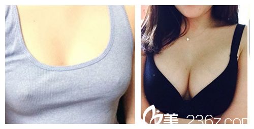 韓國ID醫(yī)院無痛假體隆胸術前術后對比圖