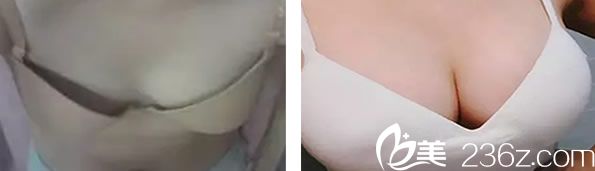 醫(yī)生自體脂肪隆胸案例