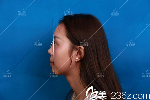 隆鼻術(shù)前照片