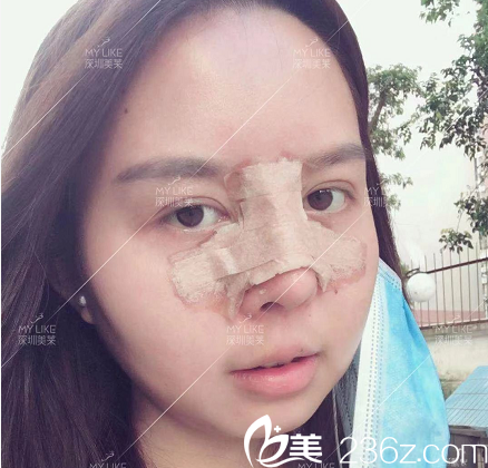 深圳美萊龍鵬輝隆鼻術(shù)后九天