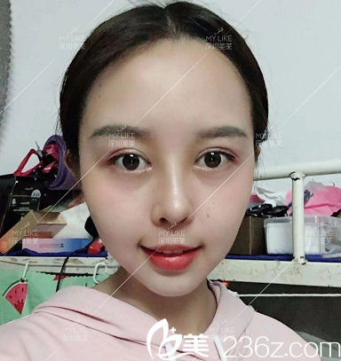 深圳美萊龍鵬輝鼻頭鼻翼縮小術(shù)后15天圖片
