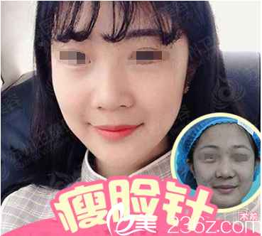 國產(chǎn)蘭州瘦臉除皺瘦臉案例 國產(chǎn)蘭州瘦臉除皺瘦臉案例