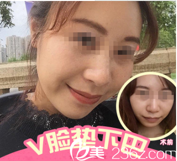 硅膠墊下巴案例 硅膠墊下巴案例