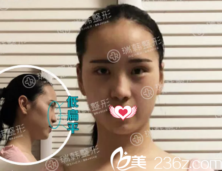 做假體隆鼻術(shù)前照 做假體隆鼻術(shù)前照