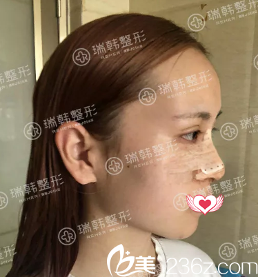 做假體隆鼻術(shù)后第3天 做假體隆鼻術(shù)后第3天