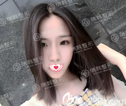 做假體隆鼻一周拆線 做假體隆鼻一周拆線