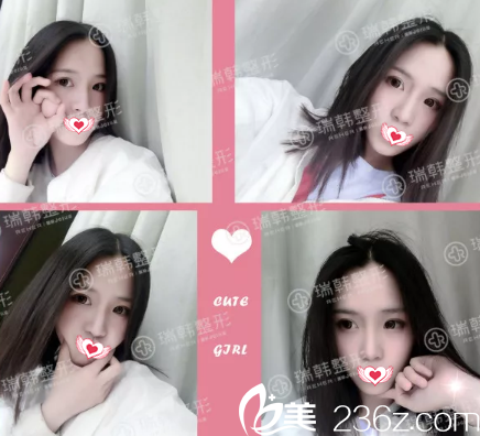 做假體隆鼻第15天效果 做假體隆鼻第15天效果