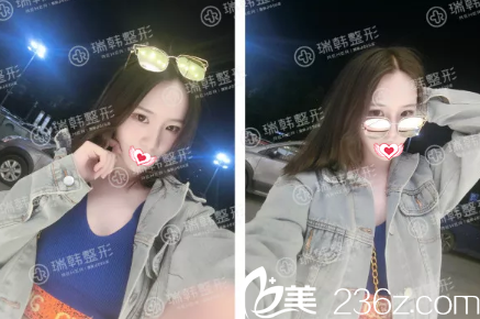 做假體隆鼻術(shù)后40天恢復(fù)效果 做假體隆鼻術(shù)后40天恢復(fù)效果