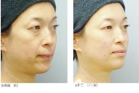 青山エルクリニック玻尿酸注射