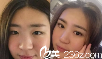 邢學斌醫(yī)生眼部整形案例