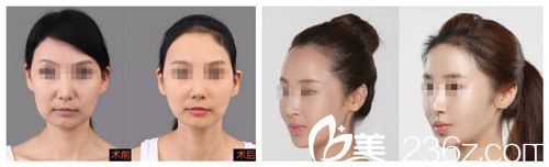 林敬華院長脂肪填充面部案例