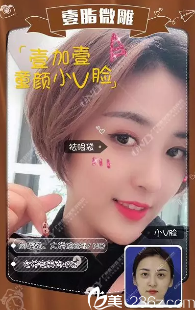 廣州壹加壹自體脂肪全臉填充實例