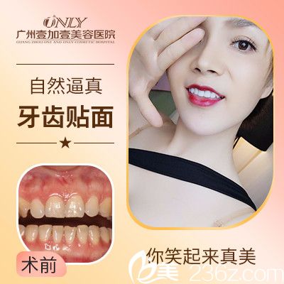 廣州壹加壹做的牙齒瓷貼面實例