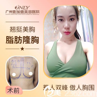 廣州壹加壹項美蓮做的自體脂肪隆胸實例