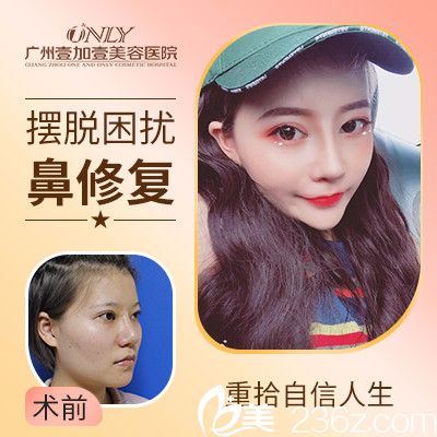 廣州壹加壹李明做的隆鼻失敗修復實例