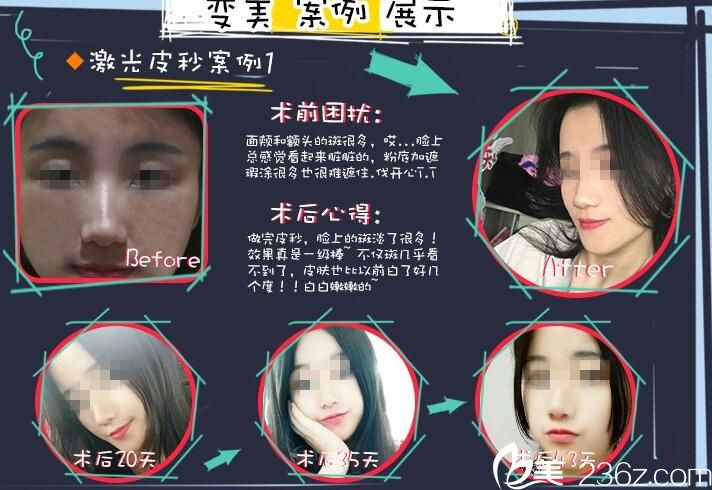 武漢亞韓蜂巢皮秒案例